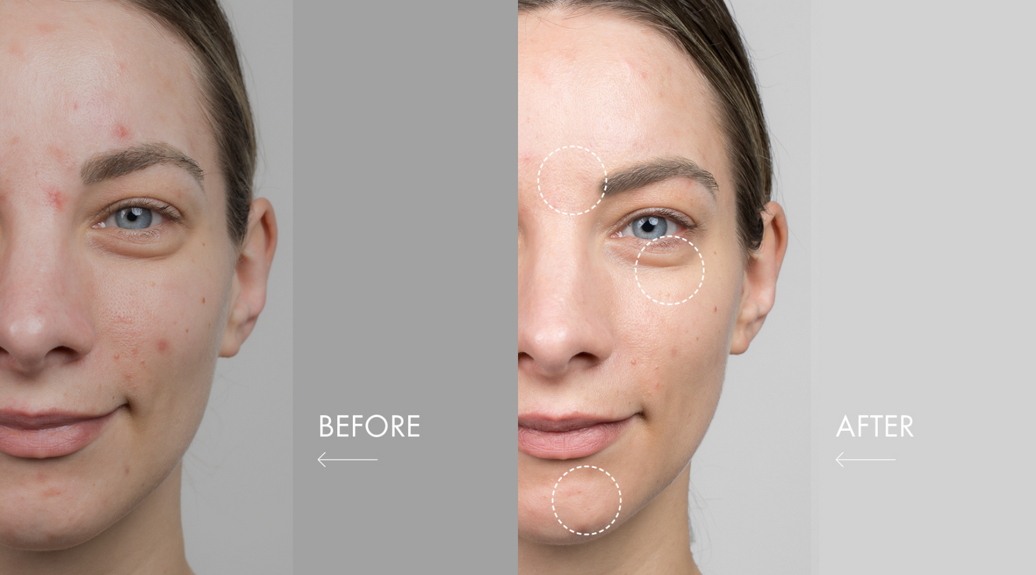 Before and after comparison of a woman's face showing reduced redness, smoother skin, and improved texture.
