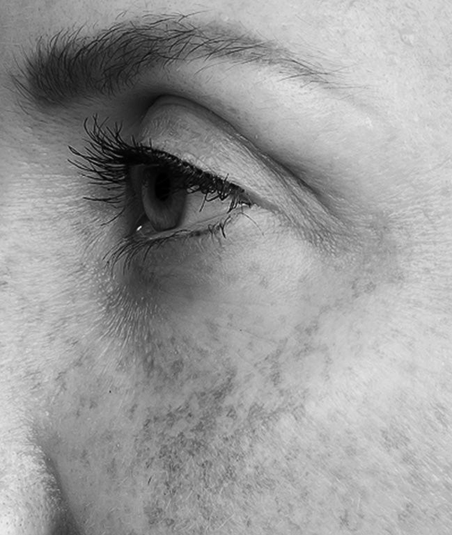 Hyperpigmentierung - QMS Medicosmetics GmbH