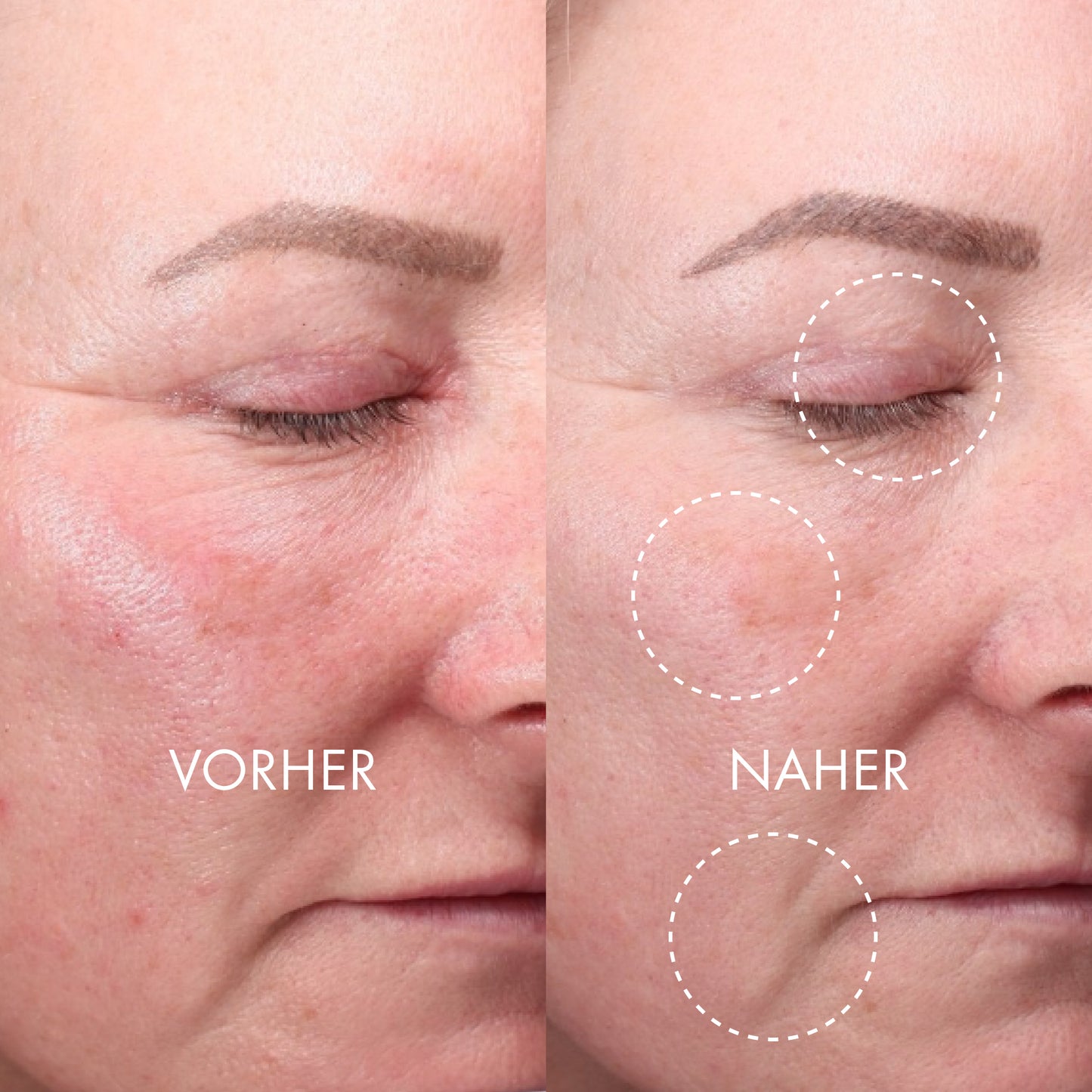 DERMA EXPERT LED Light Treatment